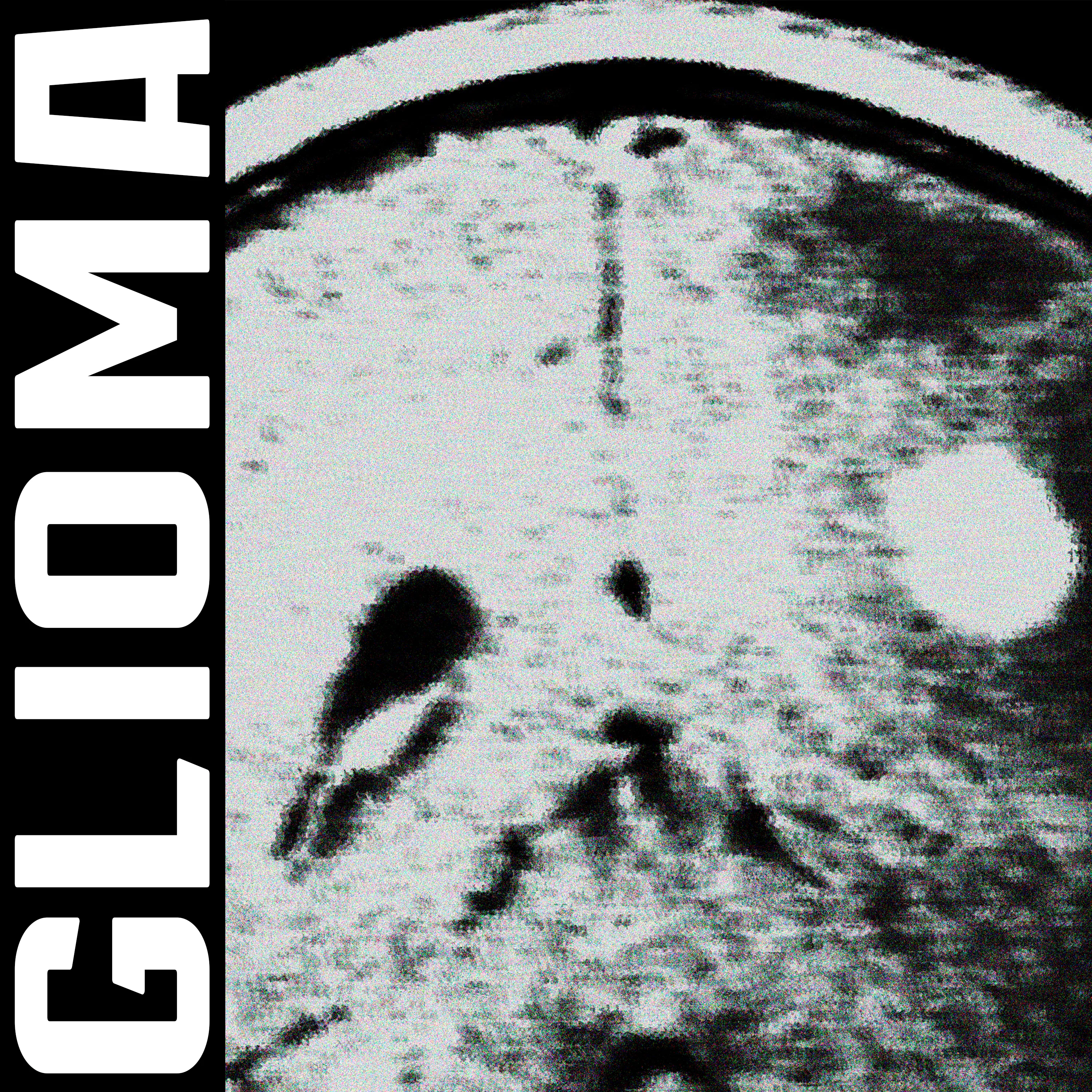 glioma